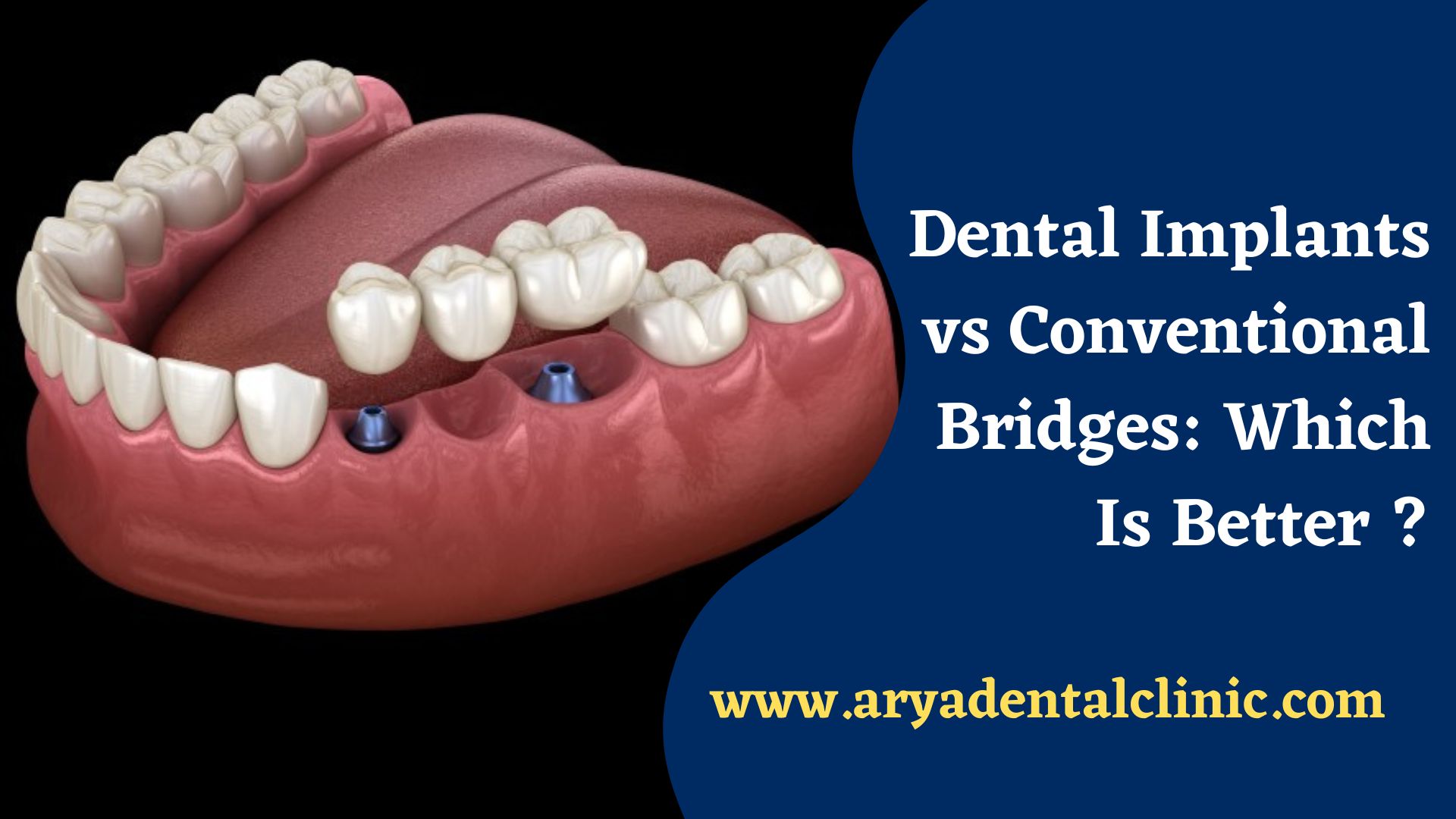 Read more about the article Dental Implants vs Conventional Bridges: Which Is Better?