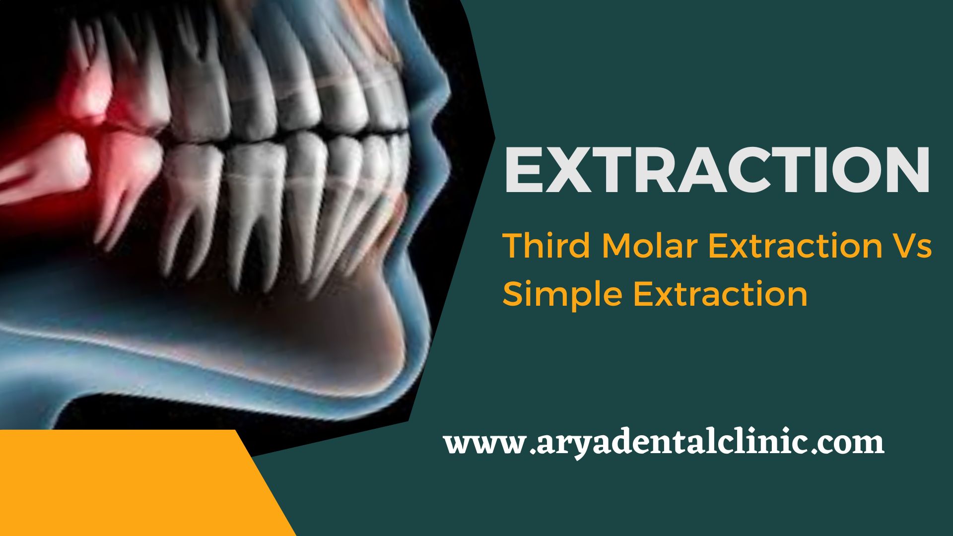 You are currently viewing Extraction:- Third Molar Extraction Vs Simple Extraction