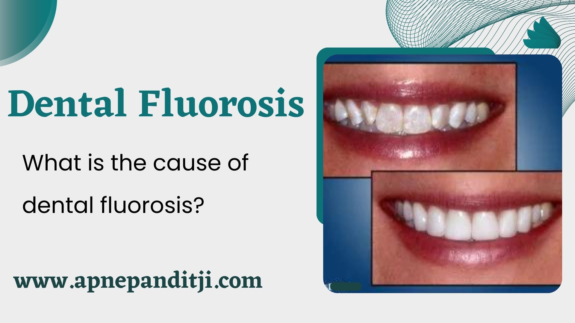 Read more about the article Dental Fluorosis:- What is the cause of dental fluorosis?